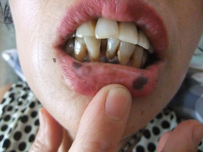 妈妈的下唇以及上下牙龈有黑色斑块