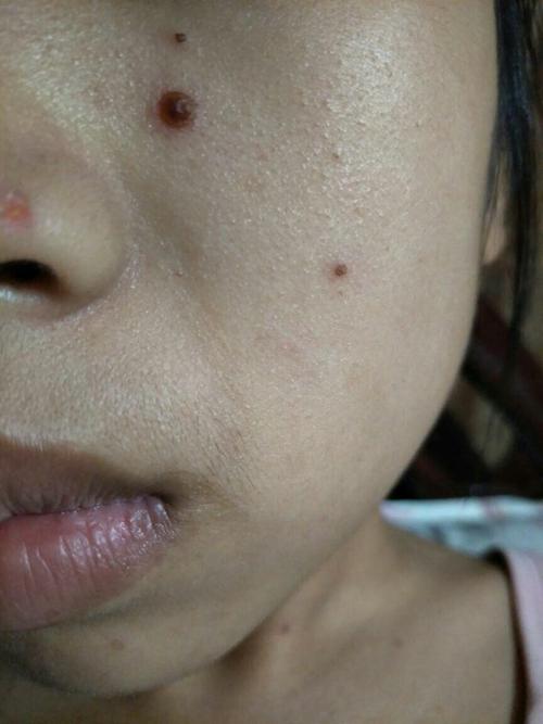脸上水痘结痂,是这个样子,会不会留疤或痘坑?