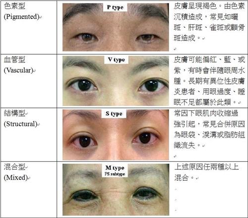 黑眼圈(dark circles)大致可分为四型如下