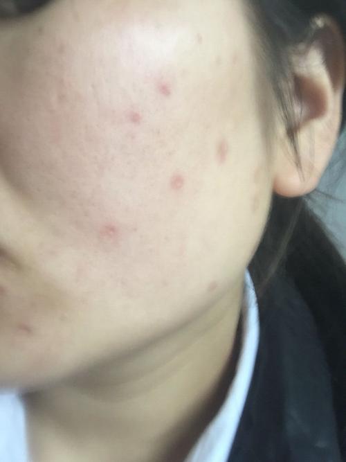 脸上水痘疤掉一个多星期了可以用马油皂洗脸吗用马油霜抹脸吗?