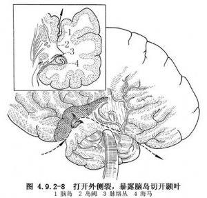 前颞叶切除术