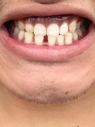 牙龈有点变紫,2年半烟龄,一天也就半包吧.求专家解释一下.